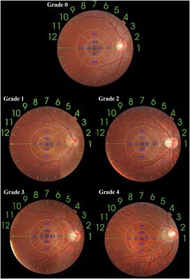 Characteristics of Fundal Changes in Fundus Tessellation in Young Adults